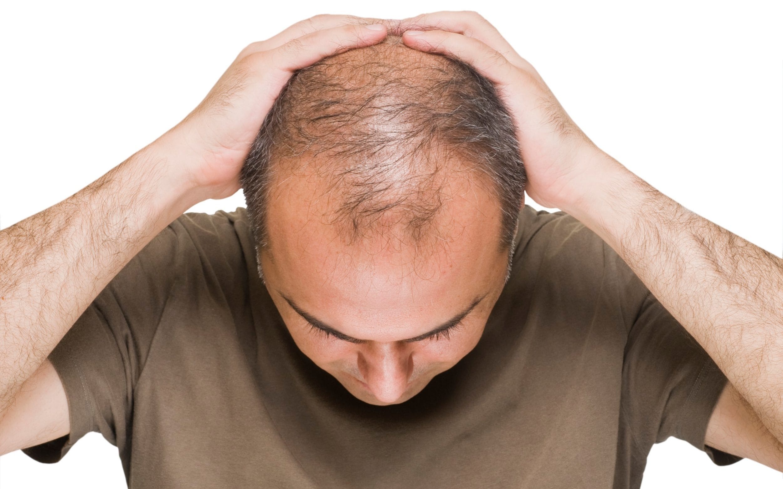 male hair loss receding hairline