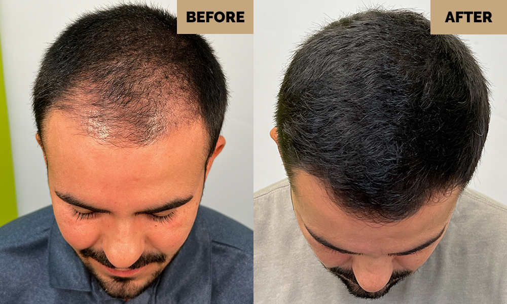 artas hair transplant before and after results