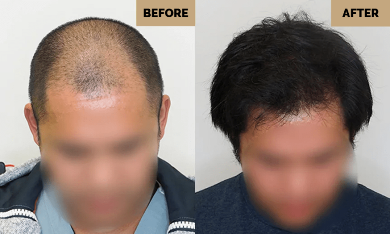 slide-1-Miami-Hair-Transplant-Hair-Loss-Doctor-in-Miami-18-1