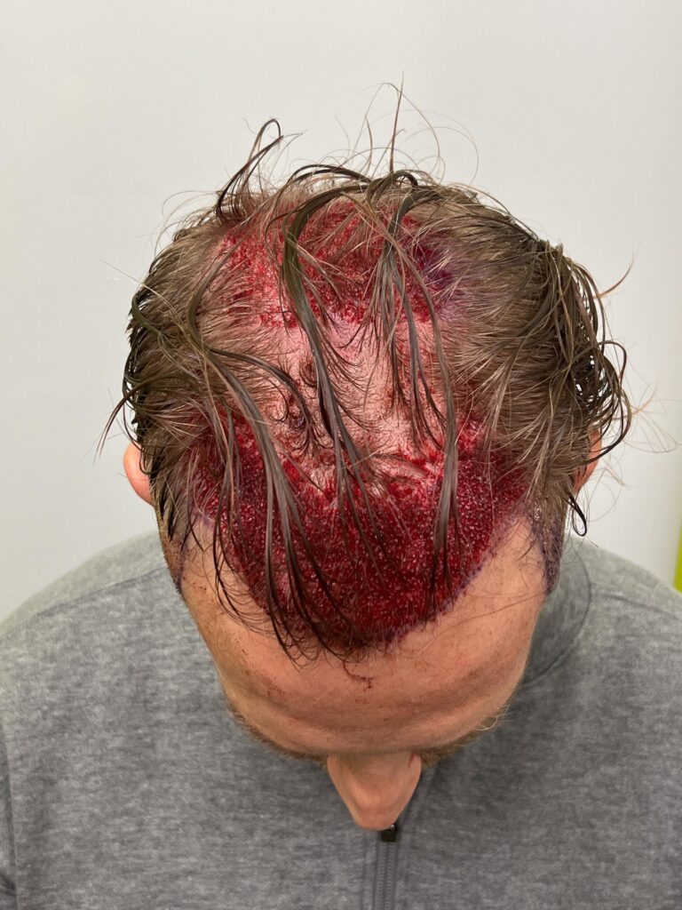 Immediately Post-Procedure